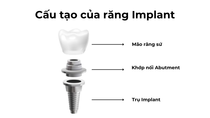 Cau-tao-cua-rang-Implant